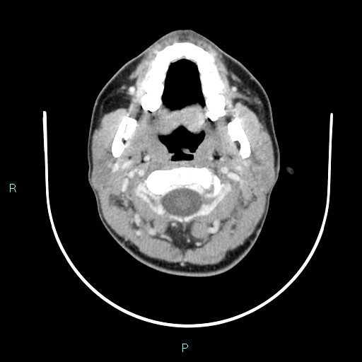 Cervical thymic cyst (Radiopaedia 88632-105335 C 90).jpg