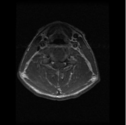 File:Cervical vertebrae metastasis (Radiopaedia 78814-91667 Axial T1 C+ 10).png