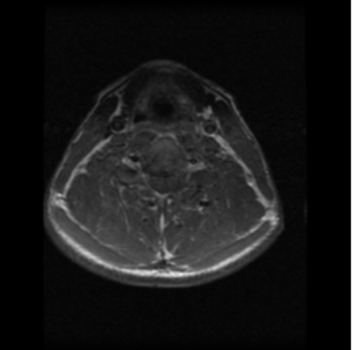 File:Cervical vertebrae metastasis (Radiopaedia 78814-91667 Axial T1 C+ 8).png