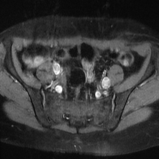 File:Cesarian section scar endometriosis (Radiopaedia 66520-75799 Axial T1 fat sat 5).jpg