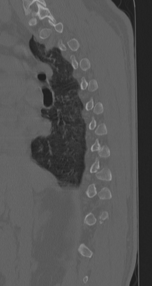 Chance fracture (Radiopaedia 33854-35020 Sagittal bone window 60).png