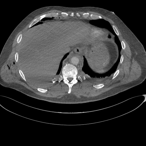 File:Chest multitrauma - aortic injury (Radiopaedia 34708-36147 A 246).png