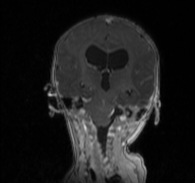 Chiari III malformation with occipital encephalocele (Radiopaedia 79446-92559 Coronal T1 C+ mpr 20).jpg