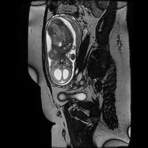 File:Chiari II malformation - fetal MRI (Radiopaedia 68099-77581 Sagittal Fiesta 17).jpg