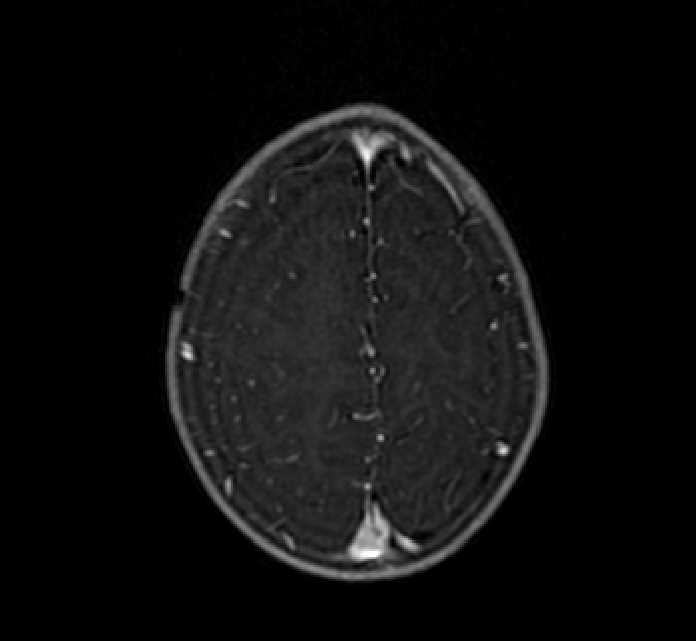 Chiasmatic-hypothalamic glioma (Radiopaedia 90079-107252 Axial T1 C+ 77).jpg