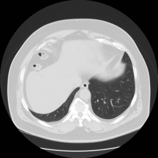 File:Chilaiditi’s syndrome (Radiopaedia 27550-27756 Axial lung window 17).jpg