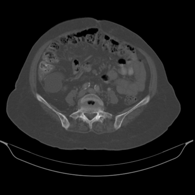 Cholangiocarcinoma (Radiopaedia 50592-56025 Axial bone window 46).jpg