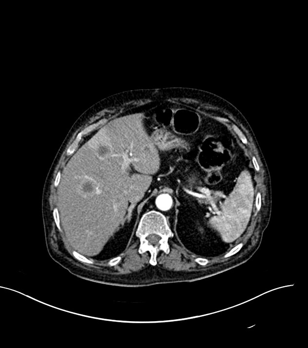 Cholangiocarcinoma with cerebral metastases (Radiopaedia 83519-98629 B 20).jpg