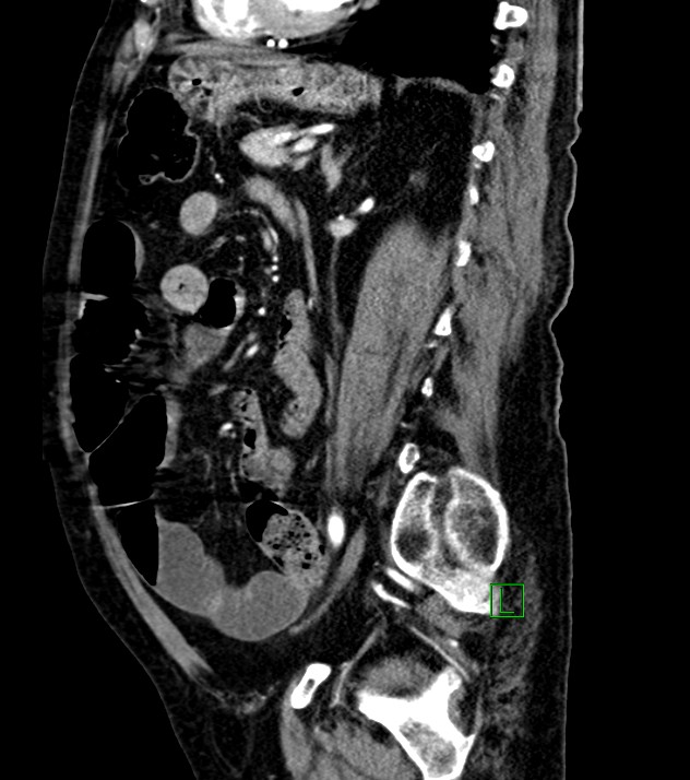 Cholangiocarcinoma with cerebral metastases (Radiopaedia 83519-98629 F 49).jpg