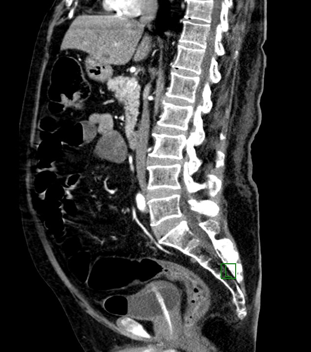 Cholangiocarcinoma with cerebral metastases (Radiopaedia 83519-98629 F 64).jpg