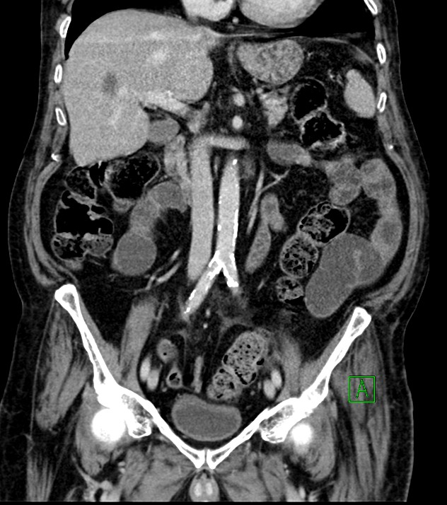 Cholangiocarcinoma with cerebral metastases (Radiopaedia 83519-98629 G 40).jpg