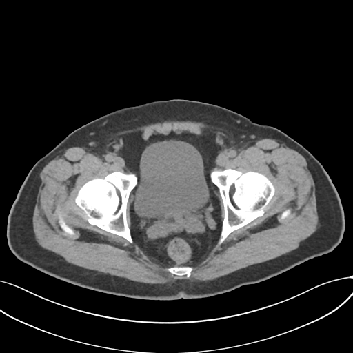 Cholecystitis with focal perforation and hepatic abscess (Radiopaedia 37189-38945 Axial non-contrast 80).png