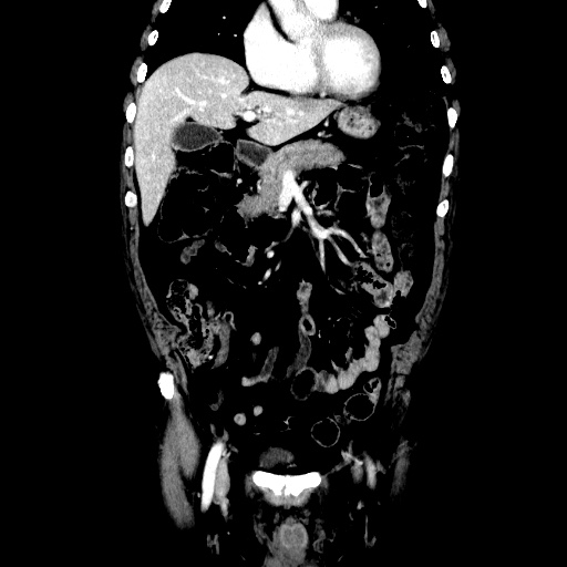 Choledocholiathiasis with normal caliber common bile duct (Radiopaedia 75368-86632 Coronal liver window 48).jpg