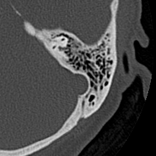 File:Cholesteatoma of the external ear (Radiopaedia 16540-16225 Axial bone window 12).jpg