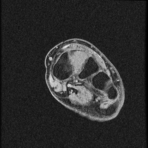 File:Chondroblastoma - midfoot (Radiopaedia 64831-73765 F 15).jpg