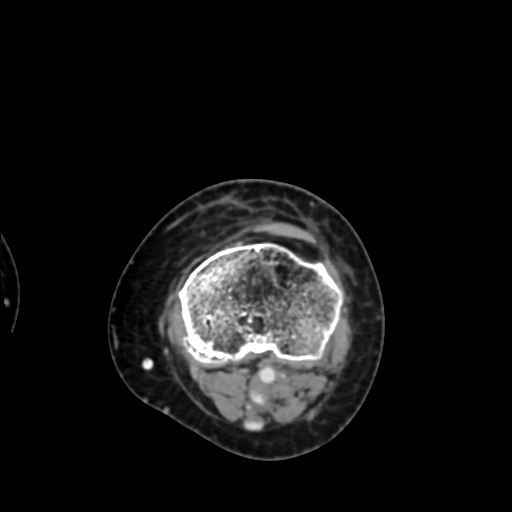 Chondrosarcoma - femur (Radiopaedia 64187-72954 Axial with contrast 64).jpg