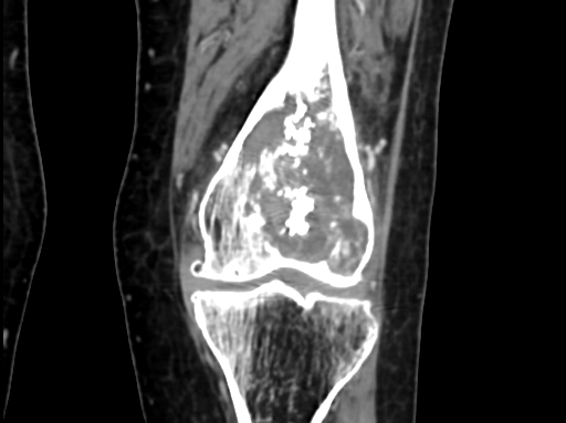 Chondrosarcoma - femur (Radiopaedia 64187-72954 C 30).jpg