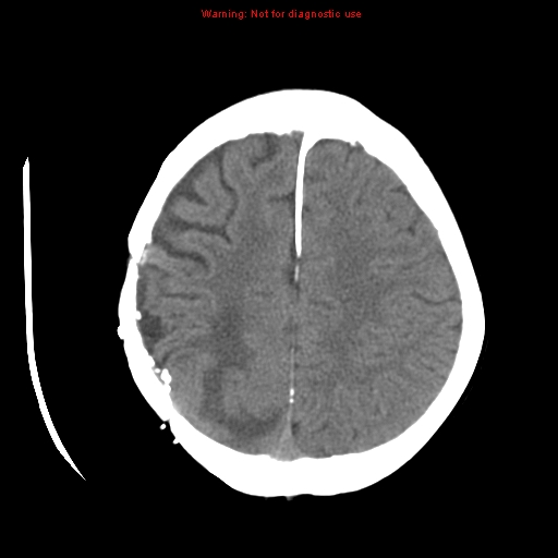 File:Choroid plexus carcinoma - recurrent (Radiopaedia 8330-9168 Axial non-contrast 21).jpg