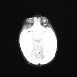 File:Choroid plexus papilloma (Radiopaedia 84612-100019 Axial DWI 11).jpg