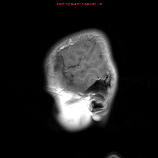 File:Choroid plexus papilloma (Radiopaedia 8466-9290 Sagittal T1 C+ 19).jpg