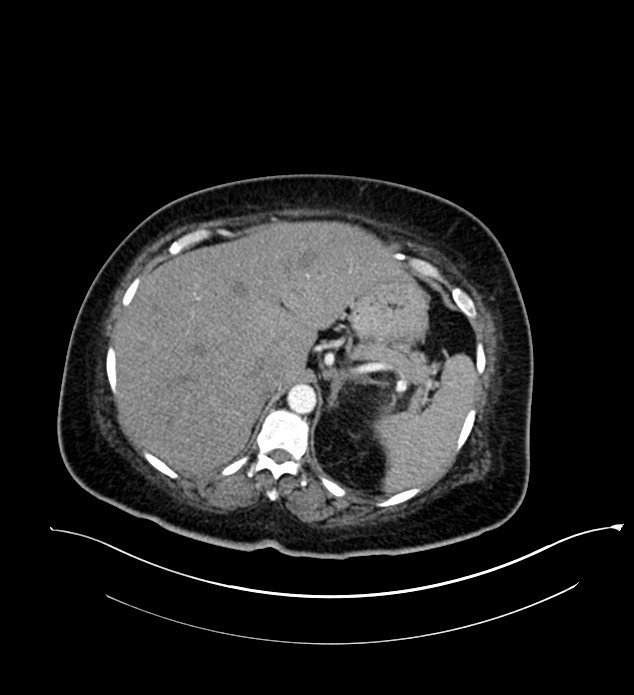 Chromophobe renal cell carcinoma (Radiopaedia 84239-99519 B 21).jpg