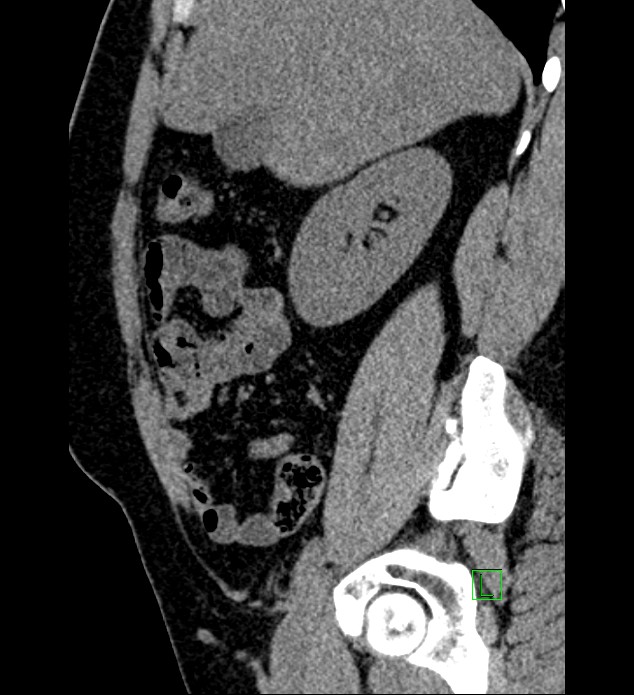 Chromophobe renal cell carcinoma (Radiopaedia 84286-99573 C 131).jpg