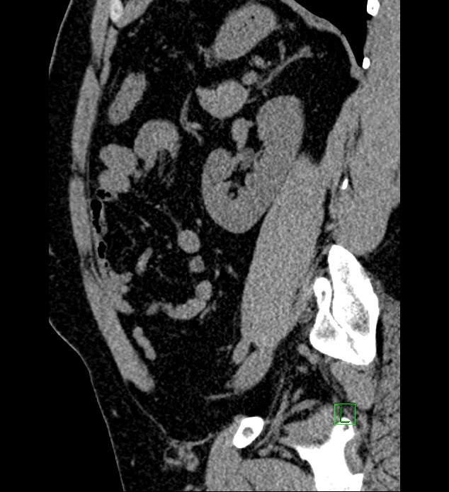 Chromophobe renal cell carcinoma (Radiopaedia 84286-99573 C 57).jpg