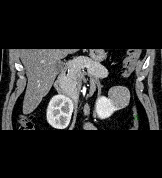 Chromophobe renal cell carcinoma (Radiopaedia 84286-99573 E 20).jpg