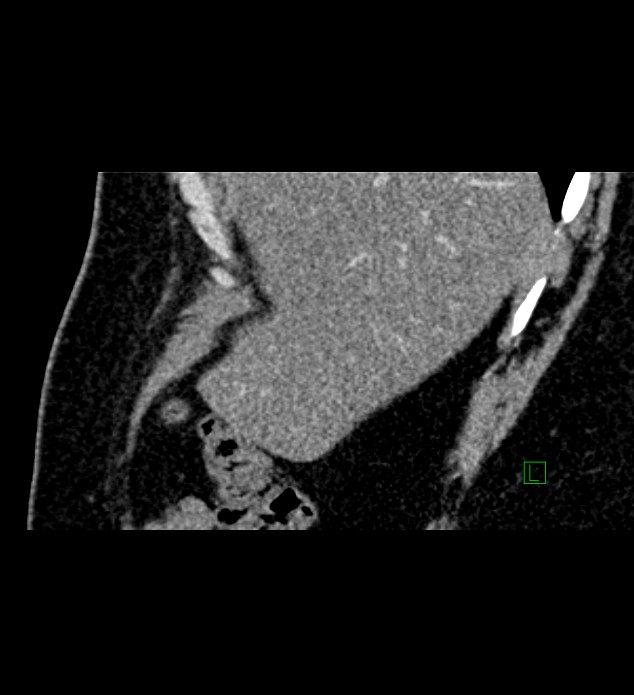 Chromophobe renal cell carcinoma (Radiopaedia 84286-99573 F 154).jpg
