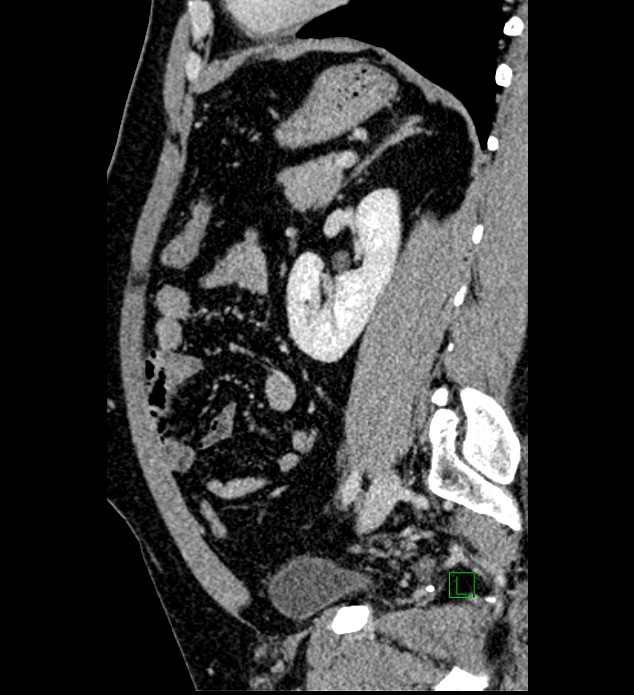 Chromophobe renal cell carcinoma (Radiopaedia 84286-99573 I 62).jpg