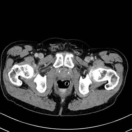 Chronic appendicitis complicated by appendicular abscess, pylephlebitis and liver abscess (Radiopaedia 54483-60700 B 147).jpg