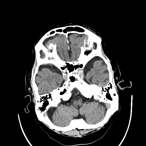 Chronic bilateral subdural hygroma (Radiopaedia 85801-101622 Axial non-contrast 31).jpg