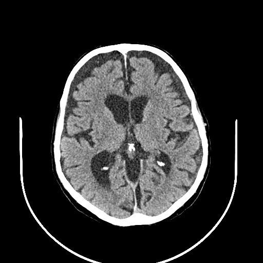 Chronic bilateral subdural hygroma (Radiopaedia 85801-101623 B 1).jpg