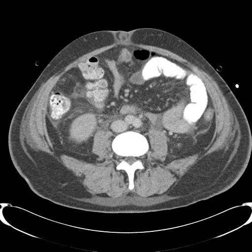 Chronic diverticulitis complicated by hepatic abscess and portal vein thrombosis (Radiopaedia 30301-30938 A 57).jpg