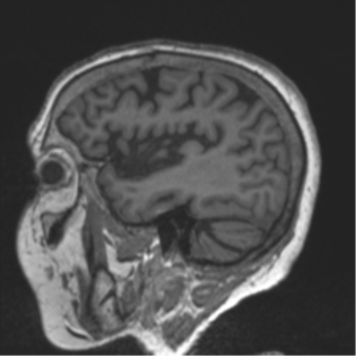 Chronic hypertensive encephalopathy (Radiopaedia 39993-42482 Sagittal T1 26).png