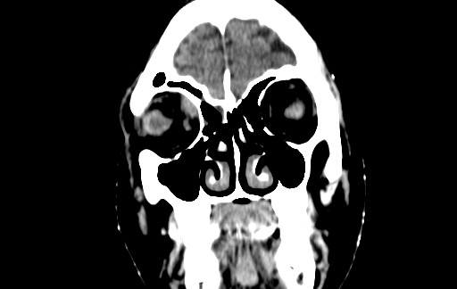 Chronic invasive fungal sinusitis (Radiopaedia 91563-109286 D 13).jpg