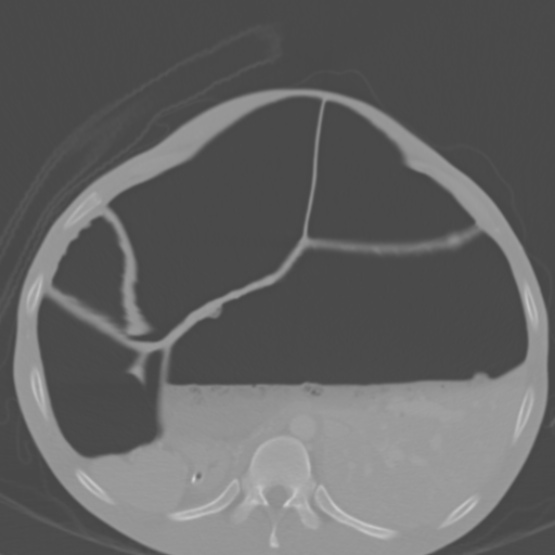 Chronic large bowel pseudo-obstruction (Radiopaedia 43181-46492 Axial bone window 56).jpg