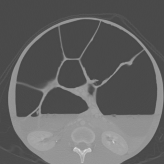 Chronic large bowel pseudo-obstruction (Radiopaedia 43181-46492 Axial bone window 93).jpg