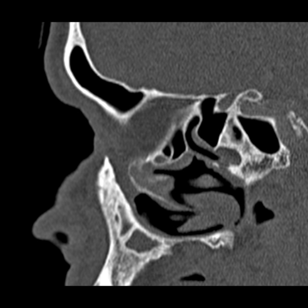 Chronic maxillary sinusitis (Radiopaedia 27879-28116 Sagittal bone window 18).jpg