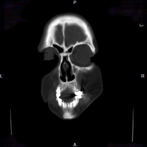File:Chronic maxillary sinusitis with a foreign body (dental filling material) (Radiopaedia 7811-8639 Coronal bone window 2).jpg