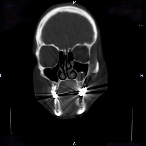 File:Chronic maxillary sinusitis with a foreign body (dental filling material) (Radiopaedia 7811-8639 Coronal bone window 5).jpg