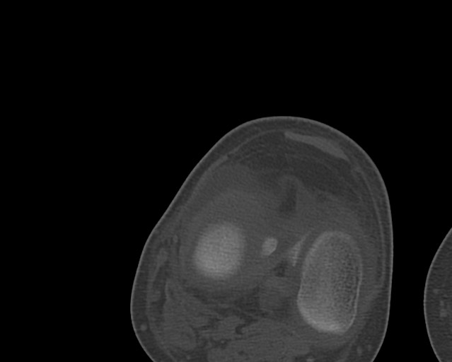 Chronic ostemyelitis of the femur with long sinus tract (Radiopaedia 74947-85982 Axial bone window 228).jpg