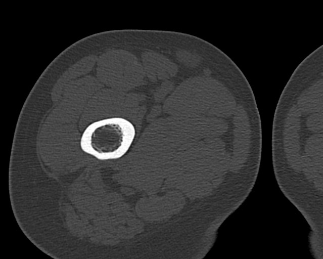 Chronic ostemyelitis of the femur with long sinus tract (Radiopaedia 74947-85982 Axial bone window 42).jpg