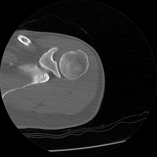 File:Chronic osteomyelitis (Radiopaedia 67597-76998 Axial bone window 6).jpg