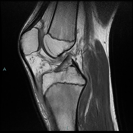 File:Chronic osteomyelitis (with Brodie abscess) (Radiopaedia 76405-88112 Sagittal PD 13).jpg