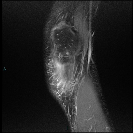 File:Chronic osteomyelitis (with Brodie abscess) (Radiopaedia 76405-88112 Sagittal PD fat sat 2).jpg