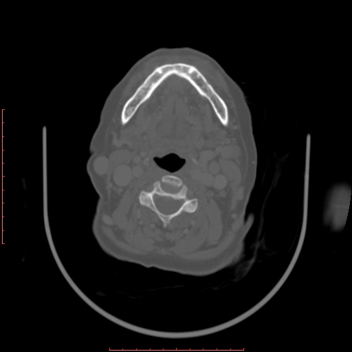Chronic osteomyelitis - maxilla (Radiopaedia 23783-23927 Axial bone window 25).jpg