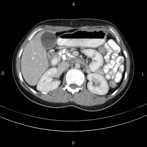 Chronic pancreatitis (Radiopaedia 64576-73450 C 56).jpg