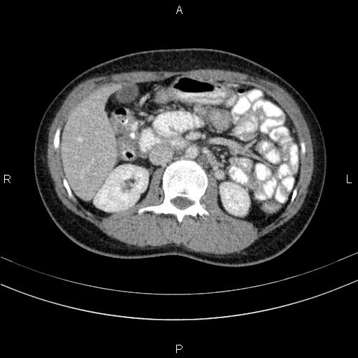 Chronic pancreatitis (Radiopaedia 64576-73450 C 70).jpg