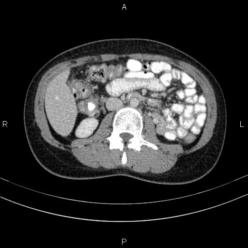 Chronic pancreatitis (Radiopaedia 64576-73450 C 81).jpg